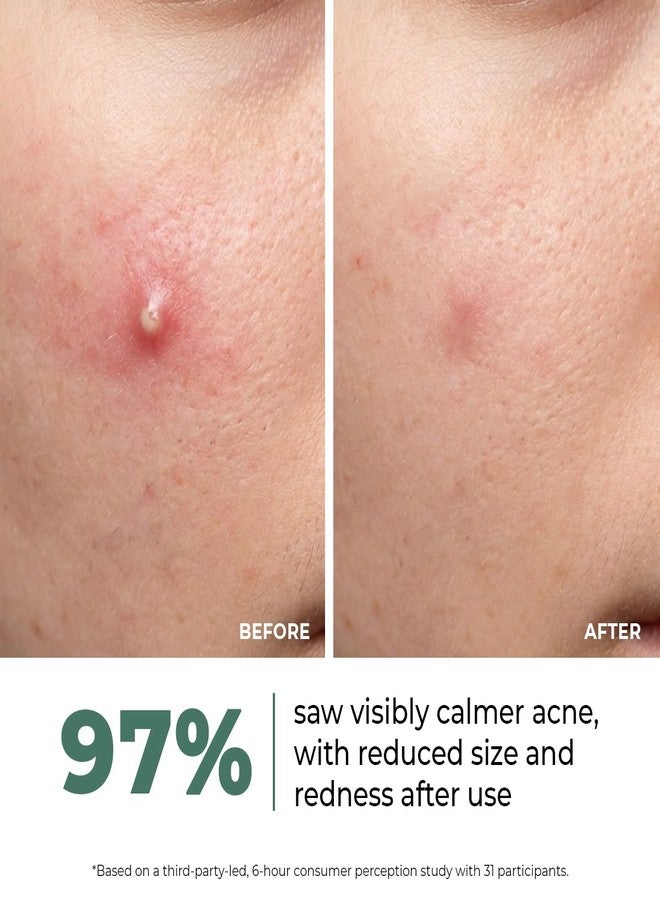 كيميائي واعي جل سيروم مصحح لحب الشباب - Image 2